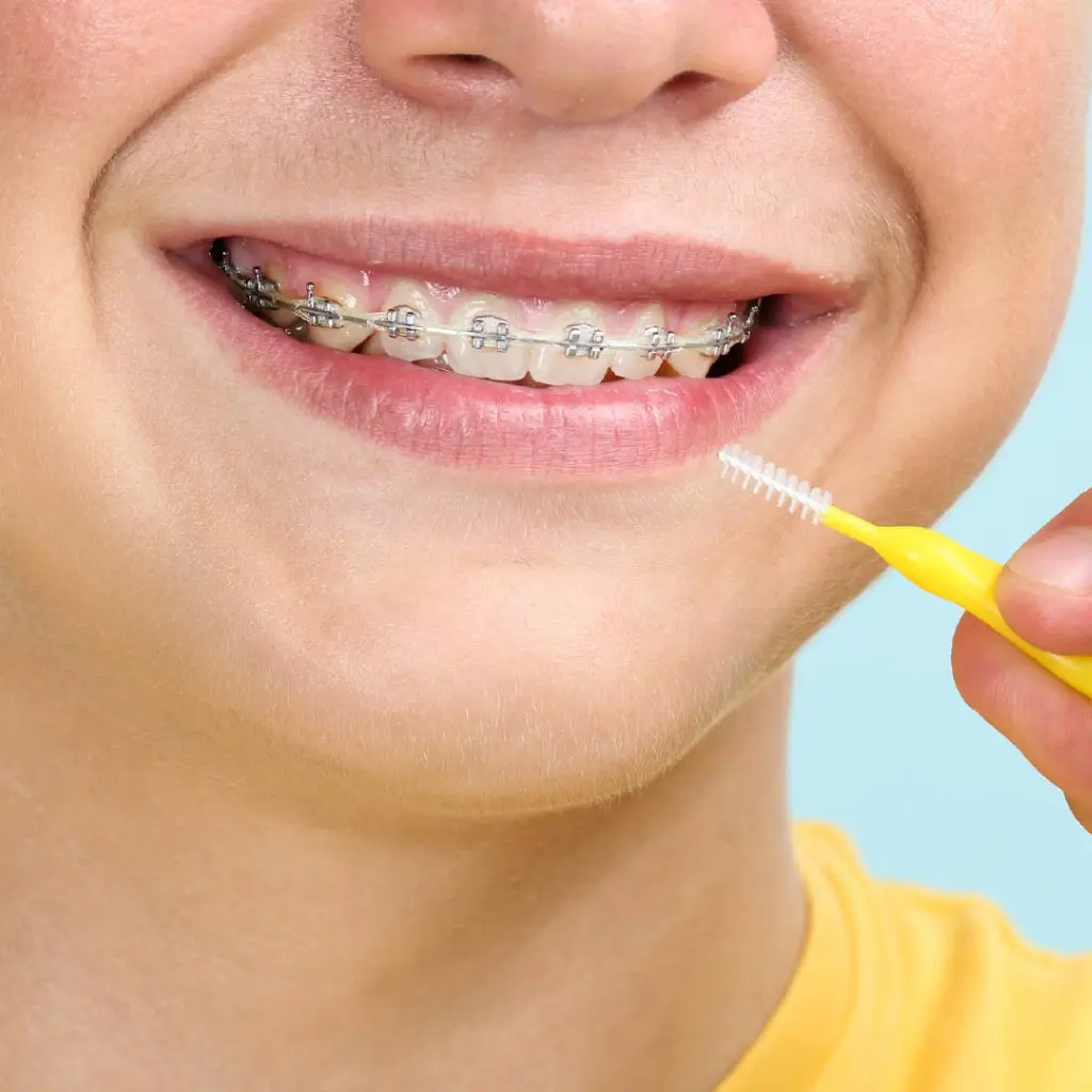 Cera de ortodoncia para aliviar las molestias de los brackets, recomendada por la clínica Ecosalud en Santiago.