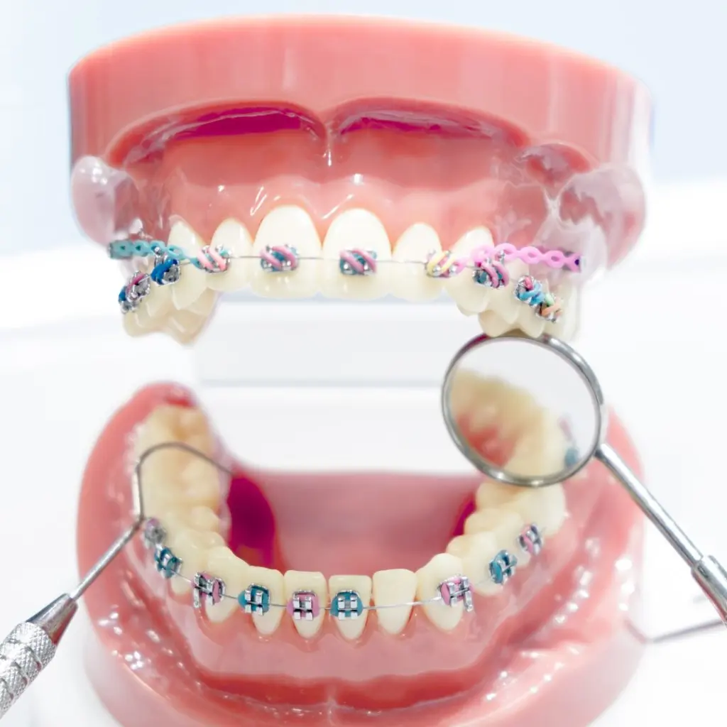 señalando con el dedo su sonrisa perfecta y alineada, mostrando el resultado exitoso de su tratamiento de ortodoncia brackets.