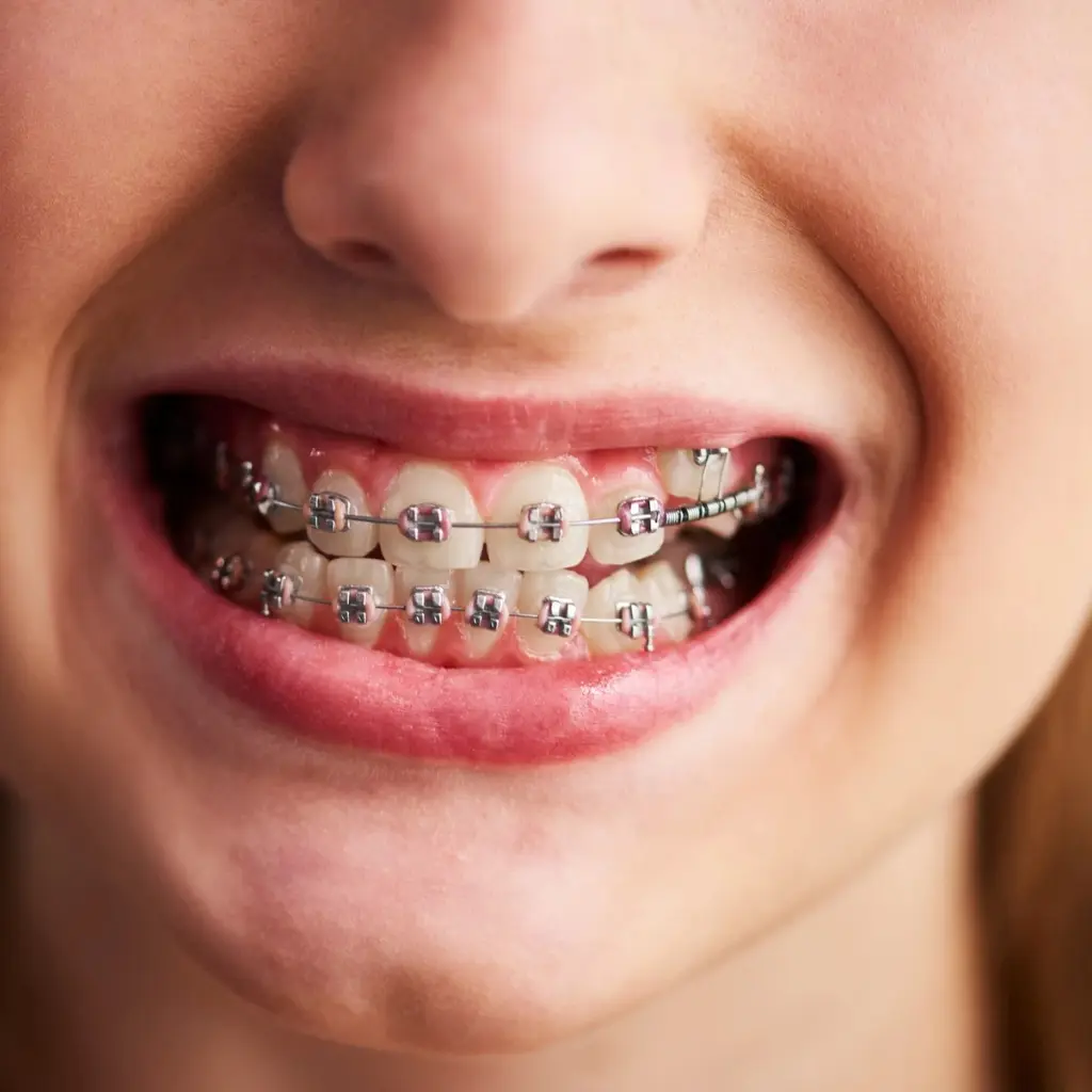 Paciente satisfecha con el tratamiento de brackets en Ecosalud logrando una sonrisa alineada.