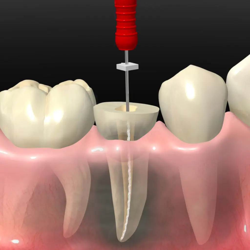 "Ilustración detallada del proceso de endodoncia dental mostrando el tratamiento de conducto en una muela. Con Ecosalud, recupera tu salud bucal